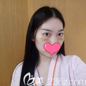 楊斐主任幫我做內(nèi)切法去眼袋術(shù)后即刻效果 楊斐主任幫我做內(nèi)切法去眼袋術(shù)后即刻效果