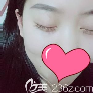 做內(nèi)切去眼袋術(shù)后15天眼袋消失皮膚恢復彈性 做內(nèi)切去眼袋術(shù)后15天眼袋消失皮膚恢復彈性