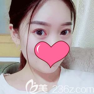 終于把30歲顯老的“罪魁禍?zhǔn)籽鄞钡轿錆h藝星用內(nèi)切法取出了，術(shù)后48天效果感覺(jué)還不錯(cuò)