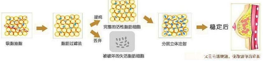 自體脂肪移植豐胸示意圖