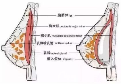 假體隆胸示意圖