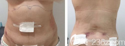 韓國(guó)腰腹環(huán)吸對(duì)媽媽臀改善大