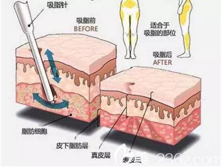 大腿吸脂手術(shù)原理