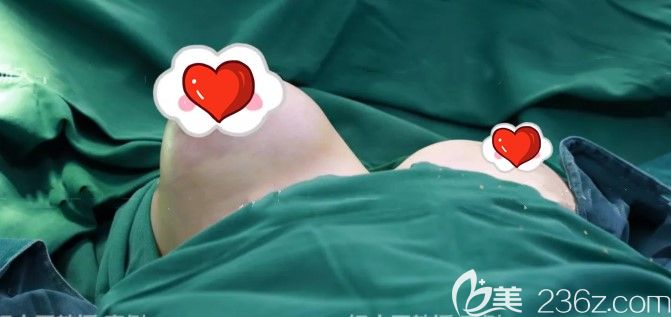 我是奧美定的受害者,訴說在福州臺(tái)江整形取胸部奧美定的經(jīng)歷讓我終于擺脫了奧美定的惡夢(mèng)