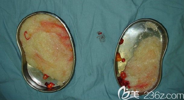 胸部奧美定取出后的異物 胸部奧美定取出后的異物