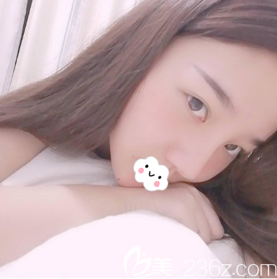 我覺得成都艾米麗潘宏偉給我做硅膠假體隆鼻鼻型好看立體不夸張都能當(dāng)案例了