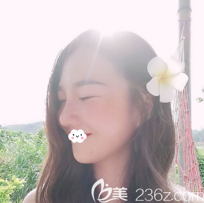 成都艾米麗硅膠假體+耳軟骨墊鼻尖術(shù)后一個月