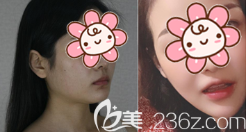 顴骨內(nèi)推真實(shí)感受和經(jīng)歷及圖