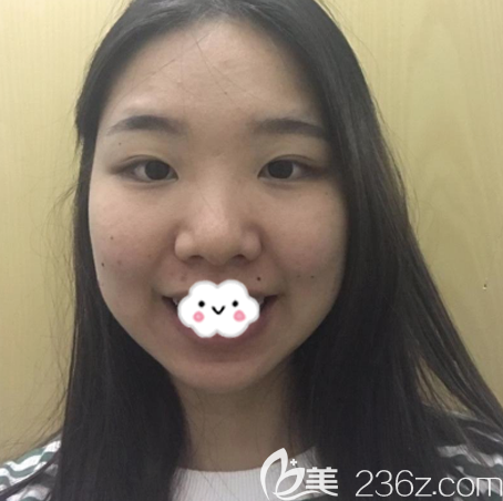 在深圳yestar藝星整形醫(yī)院做雙眼皮術(shù)前照片 在深圳yestar藝星整形醫(yī)院做雙眼皮術(shù)前照片