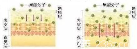 果酸煥膚的原理