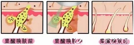 果酸煥膚能夠治療痘痘和痤瘡嗎？