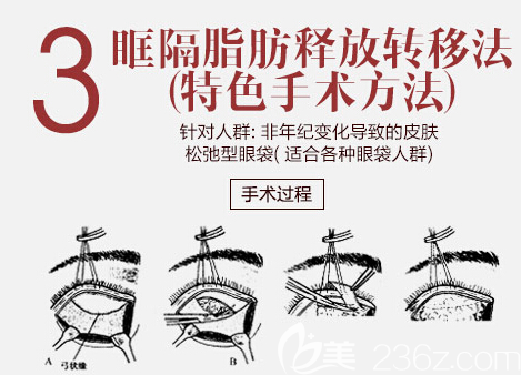 眶隔脂肪釋放去眼袋手術(shù)原理