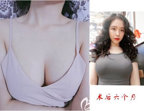 感謝昨天勇敢的我選擇韓國普羅菲耳鄭在皓做水滴假體隆胸