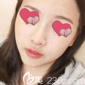 做硅膠假體隆鼻術(shù)前照 做硅膠假體隆鼻術(shù)前照