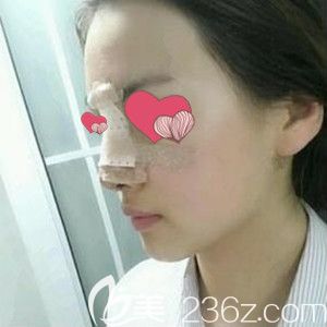 硅膠假體隆鼻術(shù)后第3天效果圖 硅膠假體隆鼻術(shù)后第3天效果圖