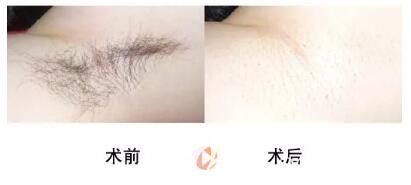 許昌博愛整形激光脫毛真人案例