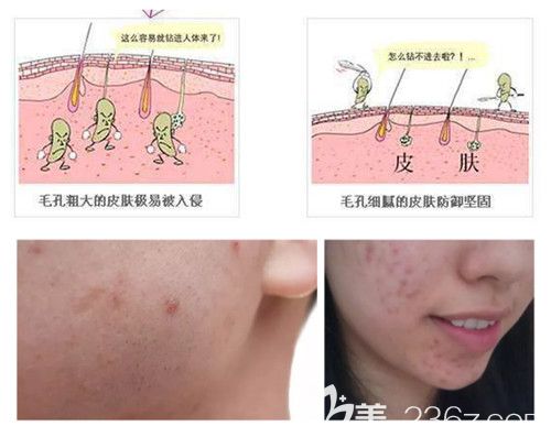 痘印的形成原因