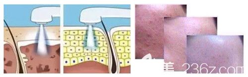 光子嫩膚去痘印原理