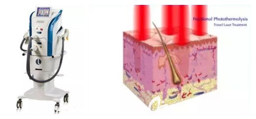 微剝脫性點陣激光去痘印原理