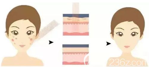 剝脫性點陣激光去痘印