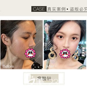 杭州藝星注射瘦臉對比<span style= 杭州藝星注射瘦臉對比<span style=