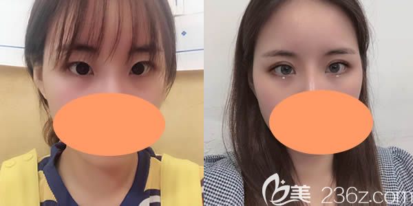 7mm雙眼皮兩個月后的真實圖片