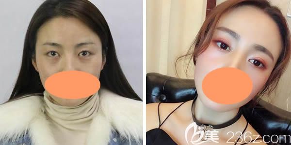 雙眼皮8mm變好一個月好后對比圖