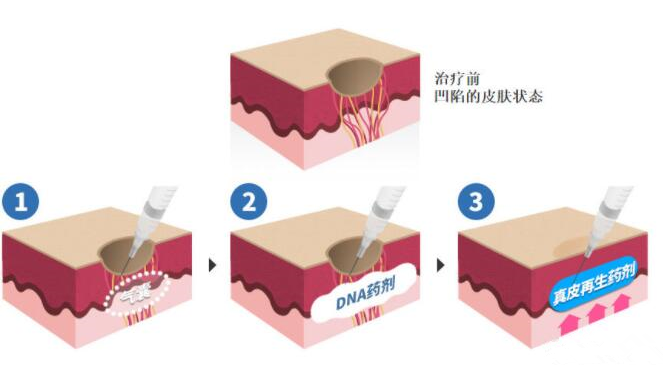 DNA真皮再生術(shù)
