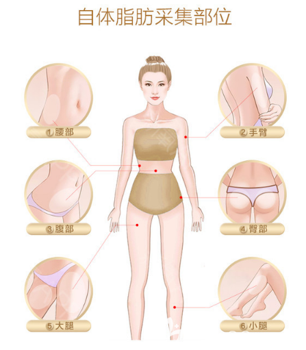 自體脂肪豐胸脂肪采集部位