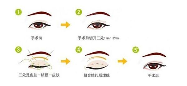 韓式雙眼皮自然嗎