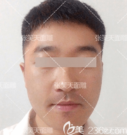 我在北京圣嘉新做顴骨顴弓內(nèi)推＋下頜角第30天效果