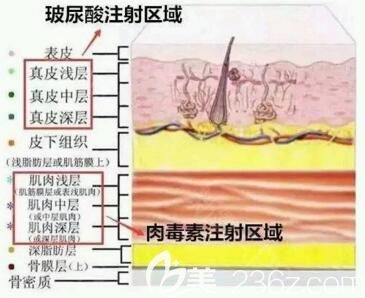 玻尿酸和除皺針的區(qū)別有哪些？