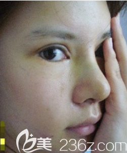 韓國愛婷鼻子雙眼皮脂肪填充顴骨6個(gè)月日記