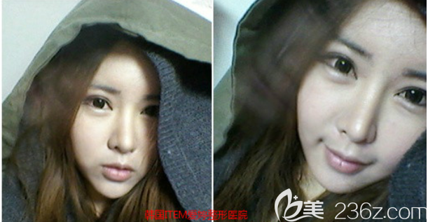 韓國(guó)愛婷鼻子雙眼皮脂肪填充顴骨6個(gè)月日記我每天都在炫耀