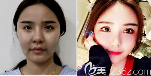 東莞壹加壹朱建生做的面部線雕埋線提升案例