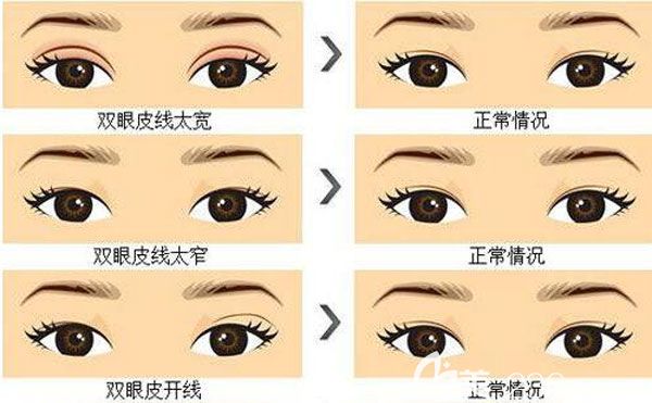 雙眼皮失敗了多久可以修復