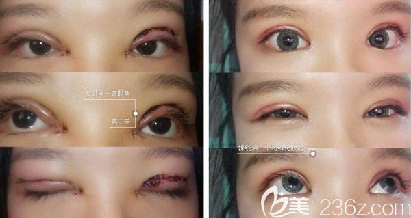 雙眼皮失敗該如何修復呢