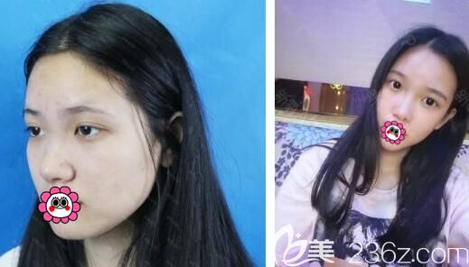 合肥韓美假體隆鼻案例