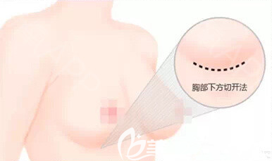 假體隆胸下皺襞切口示意圖