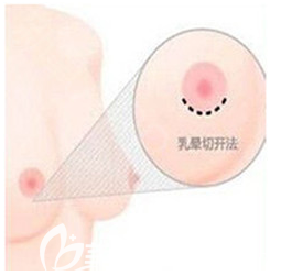 假體隆胸乳暈切口示意圖