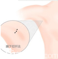 假體隆胸腋下切口示意圖