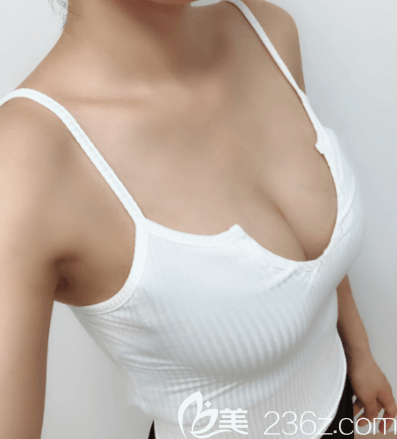 北京圣嘉新李朕自體脂肪豐胸案例