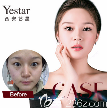 西安藝星隆鼻案例