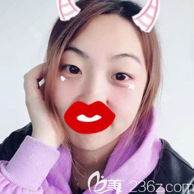 在洛陽毛大夫做眼綜合手術前 在洛陽毛大夫做眼綜合手術前