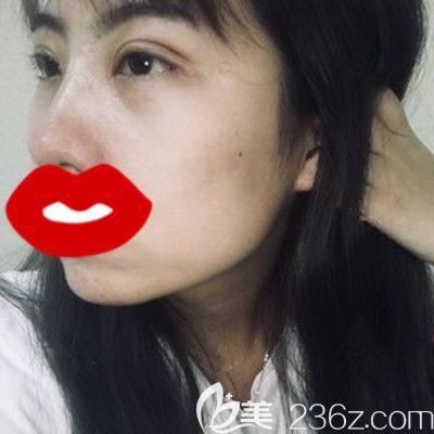 在洛陽毛大夫做眼綜合手術15天后 在洛陽毛大夫做眼綜合手術15天后