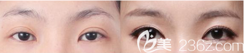 韓式三點式雙眼皮術(shù)后效果圖