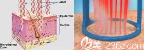 激光去妊娠紋原理