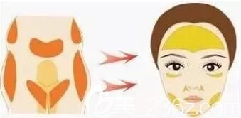 自體脂肪面部填充術(shù)