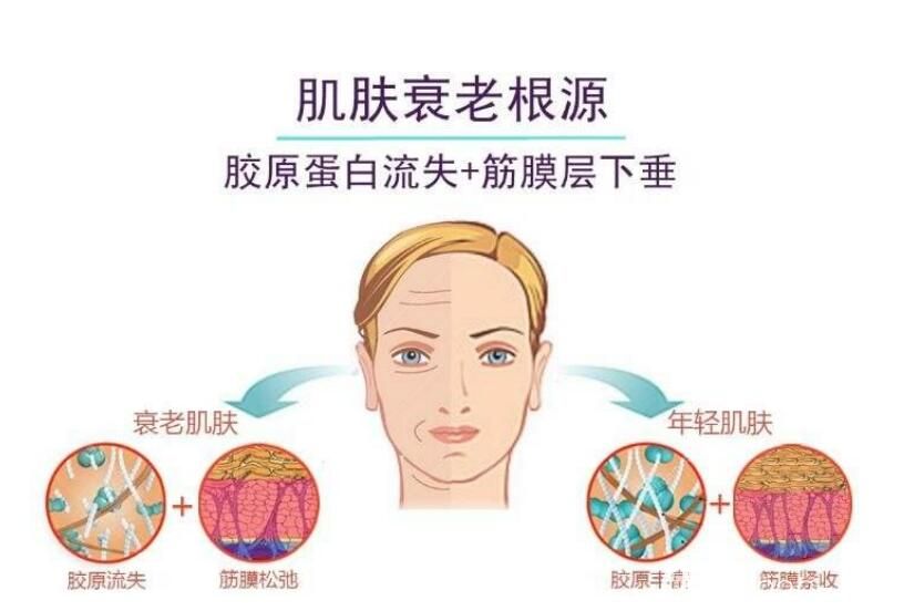 面部提升術價格介紹