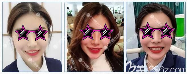 深覆合矯正過程中